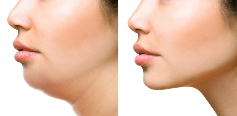 Cómo quitar la papada